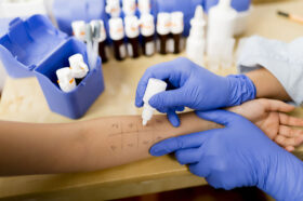 Closeup of a Doctor Applying a Solution to a Patient’s Arm During an Allergy Skin Test Do Allergy Skin Tests Hurt